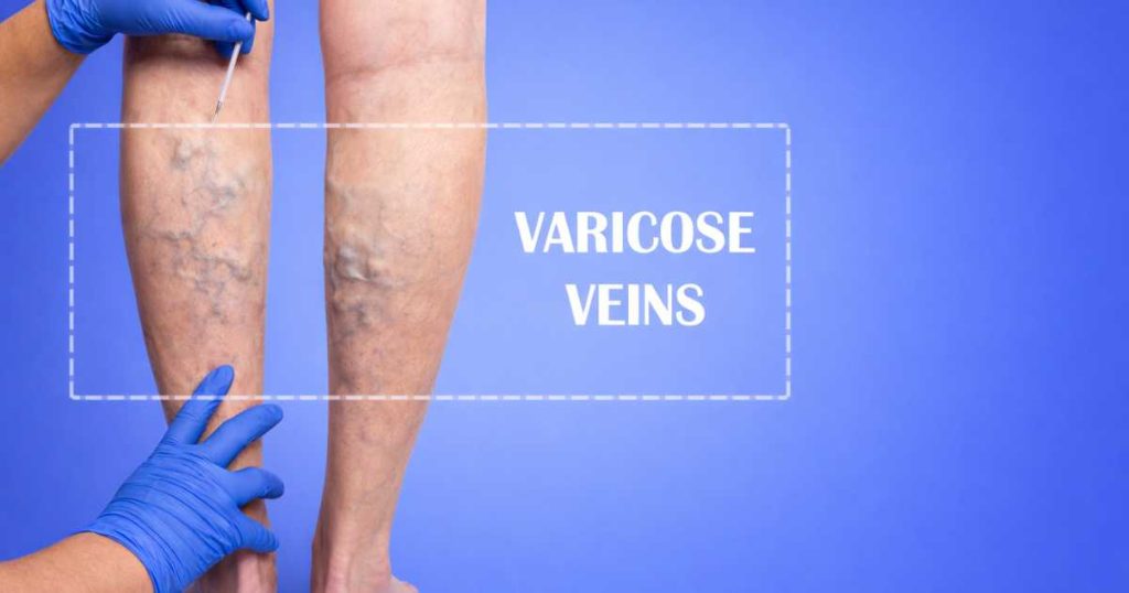 Are Varicose Veins Dangerous If Left Untreated
