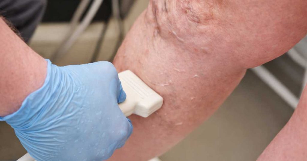 How Doctors Diagnose Varicose Veins