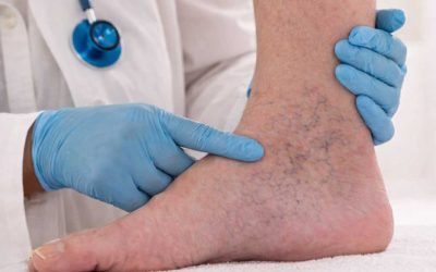 Varicose Veins Treatment: Understanding the Diagnosis and Specialized Treatments for Active Lifestyles