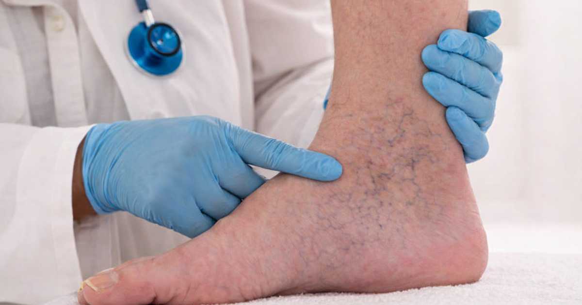 Varicose Veins Treatment: Understanding the Diagnosis and Specialized Treatments for Active Lifestyles