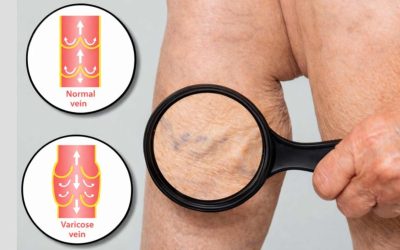 What Are Varicose Veins? Causes, Symptoms & Early Treatment Guide