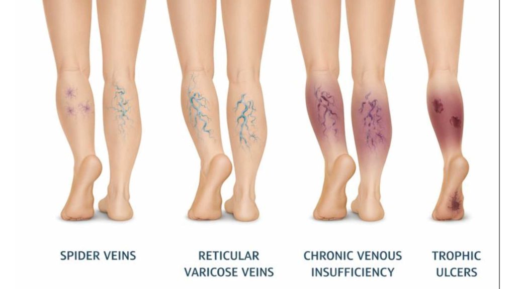 Early Signs and Progression