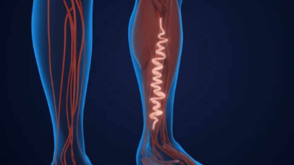 The Science of Venous Insufficiency