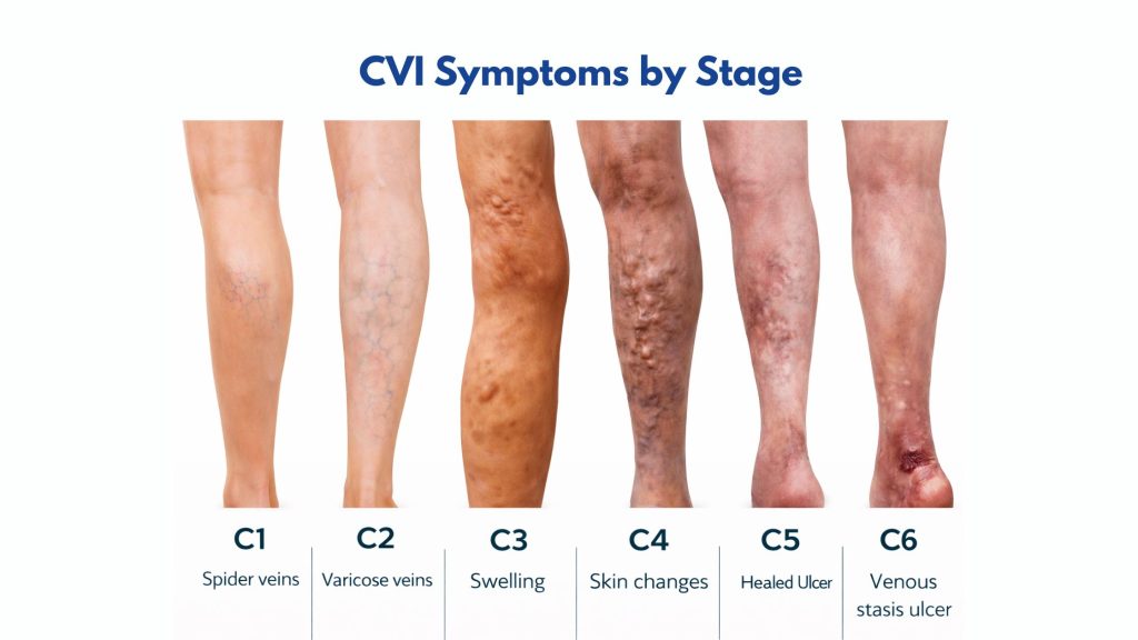 CVI Symptoms by Stage