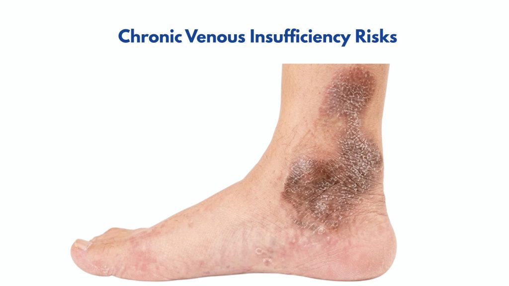Chronic Venous Insufficiency Risks