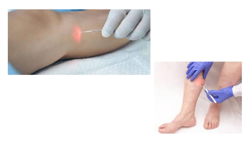 EVLA vs. Traditional Vein Stripping: A Direct Comparison