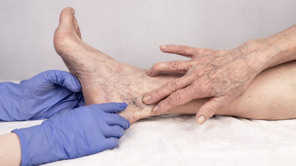 Early Signs of Spider Veins