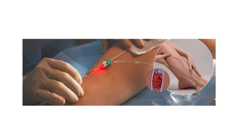 How the Endovenous Laser Therapy Procedure Works?