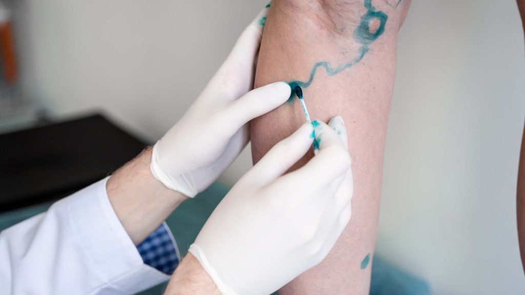 How to Get Rid of Spider Veins and Varicose Veins