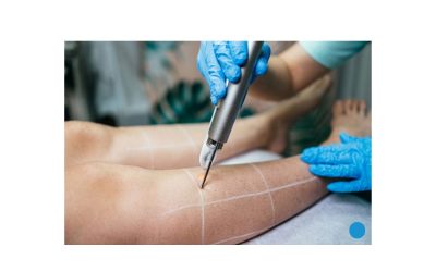 Is Endovenous Laser Ablation Treatment Safe? Benefits, Risks & Results Explained