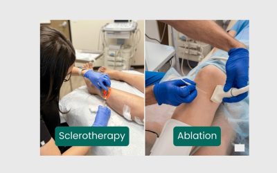 Sclerotherapy vs Laser Ablation: Best Venous Reflux Disease Treatment Explained