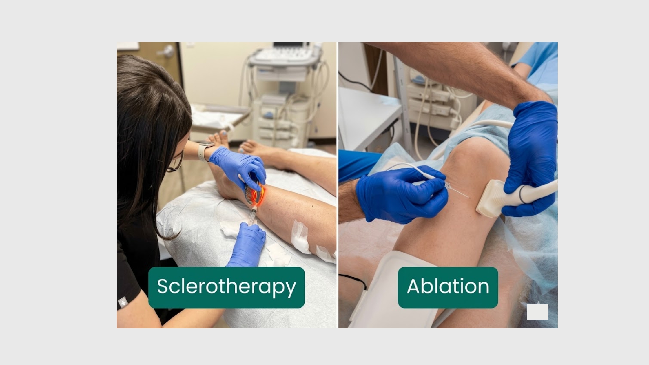 Sclerotherapy vs Laser Ablation: Best Venous Reflux Disease Treatment Explained