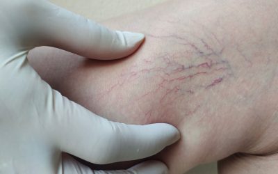 Spider Vein: Early Signs, Prevention, and When to See a Cardiologist