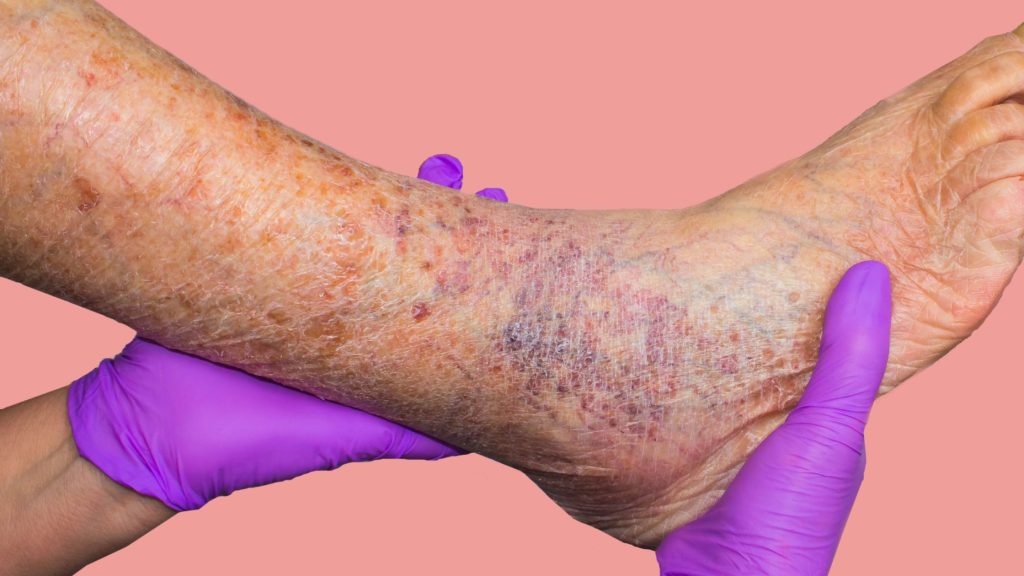 Spider Veins vs. Varicose Veins