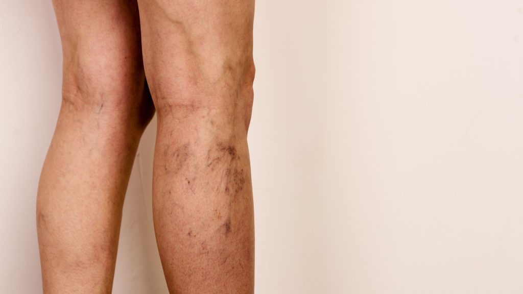 Understanding Spider Veins