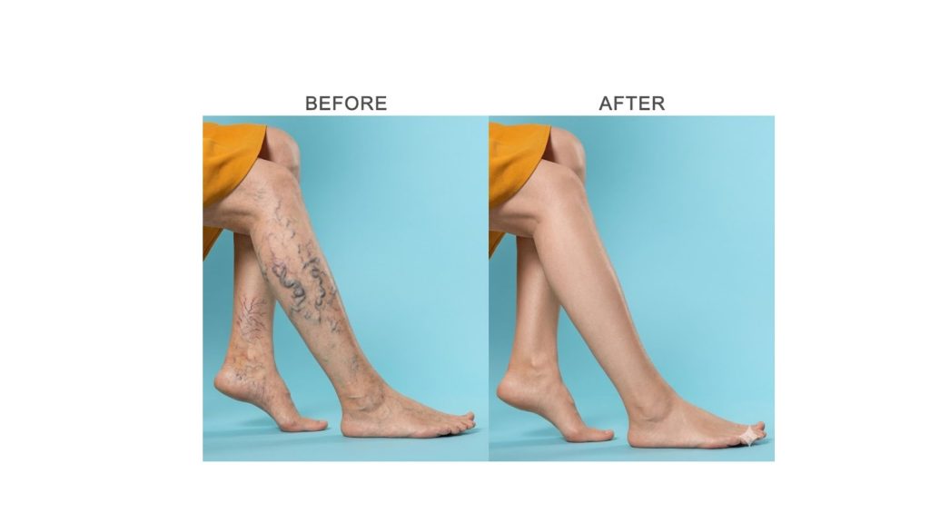 Varicose Veins Laser Treatment Recovery Time: What to Expect