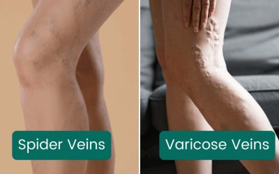 Varicose Veins vs Spider Veins: Key Differences You Should Know