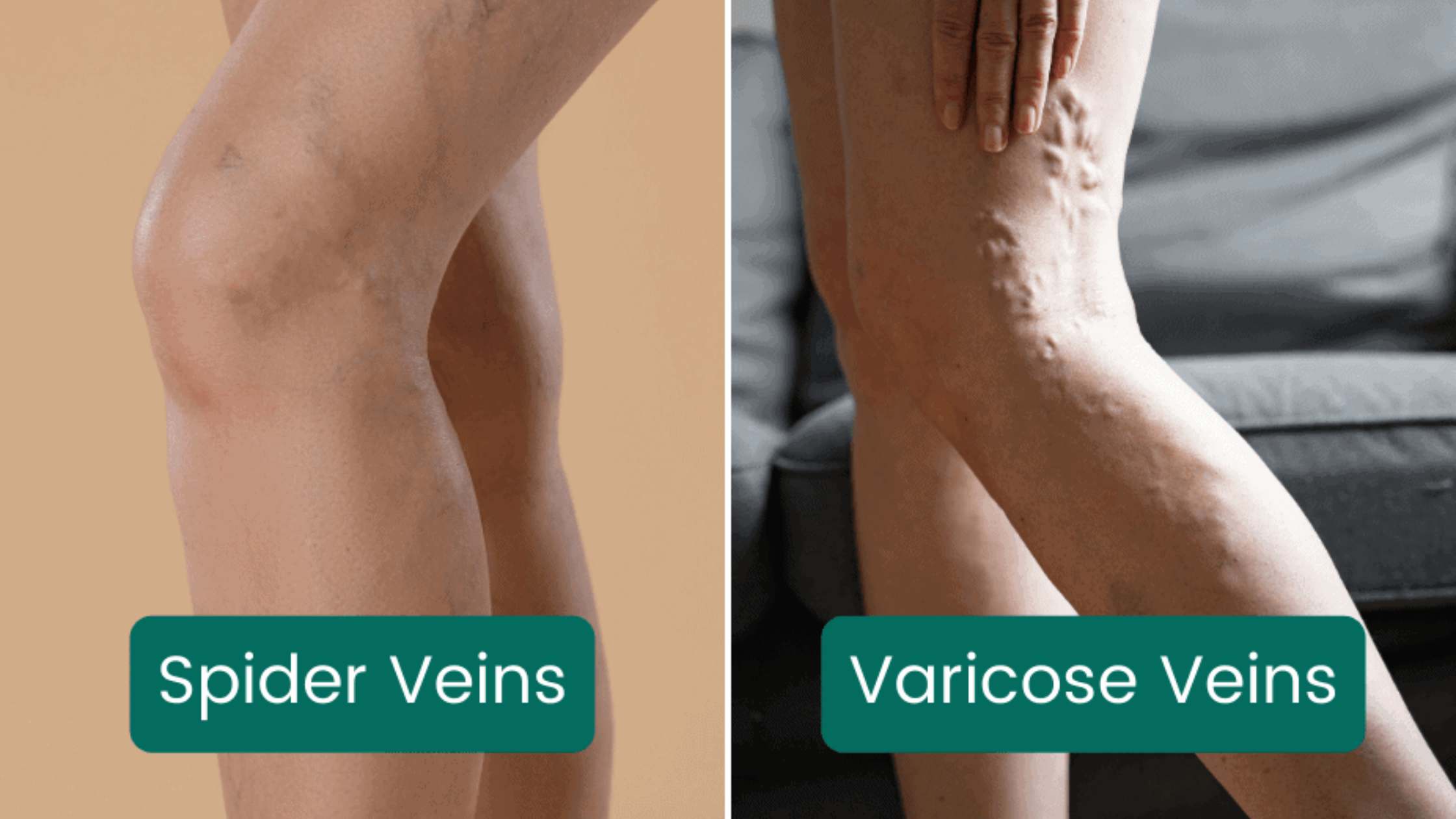 Varicose Veins vs Spider Veins: Key Differences You Should Know