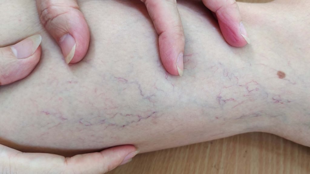 What Are Varicose Veins?