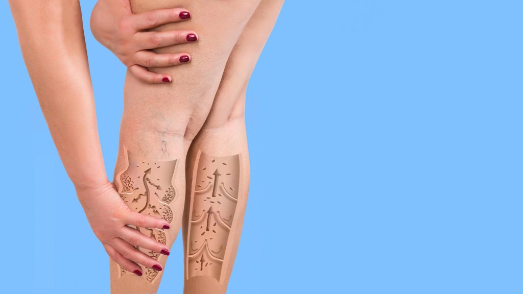 What Causes Spider Veins?