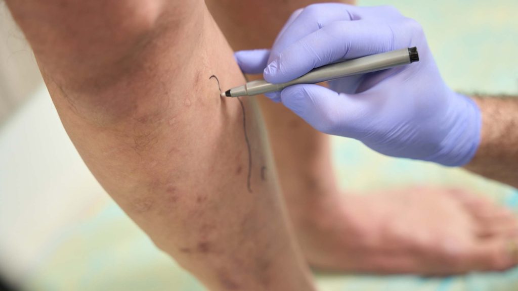 What Causes Spider Veins and Varicose Veins?