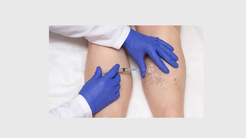 What Is Sclerotherapy? How It Treats Venous Reflux Disease