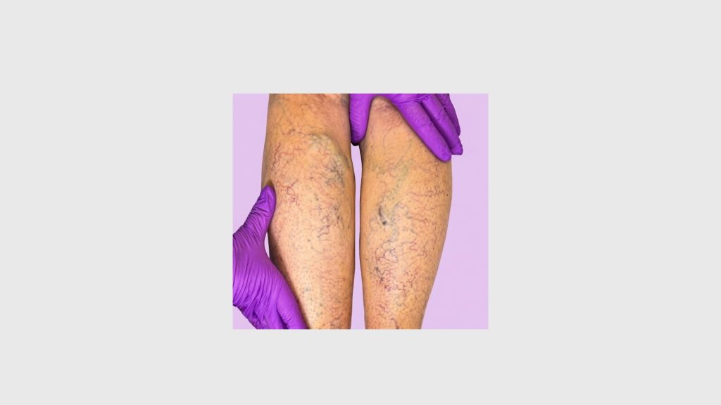 Which Venous Reflux Disease Treatment Is Better?