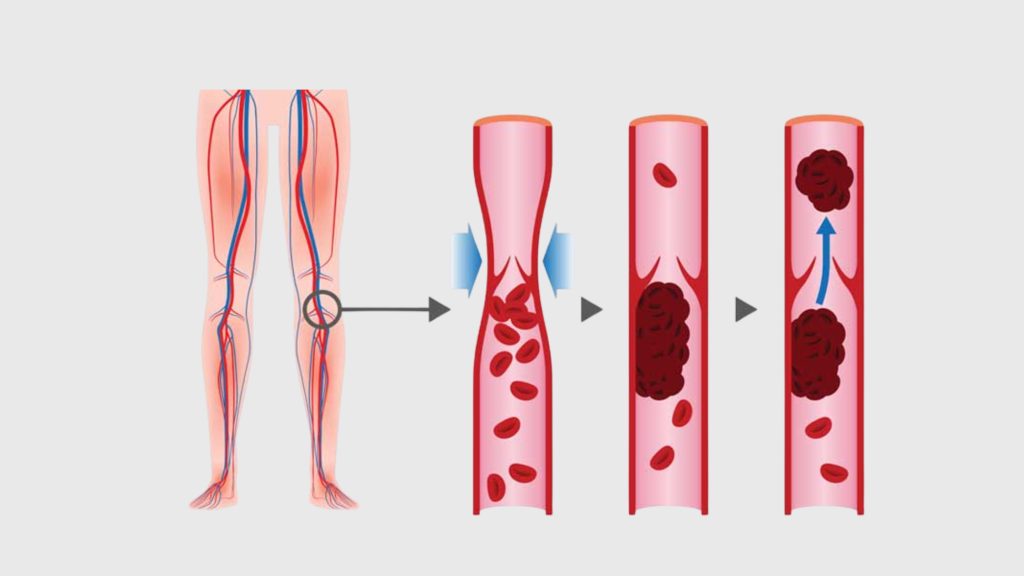 Why is Early Treatment of Venous Reflux Disease Important?