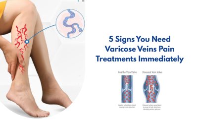 5 Signs You Need Varicose Veins Pain Treatments Immediately