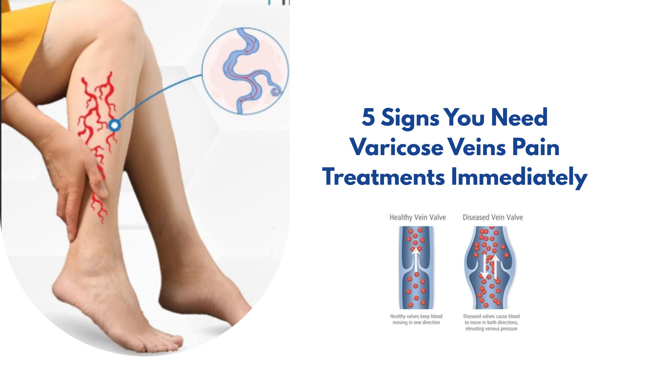 5 Signs You Need Varicose Veins Pain Treatments Immediately