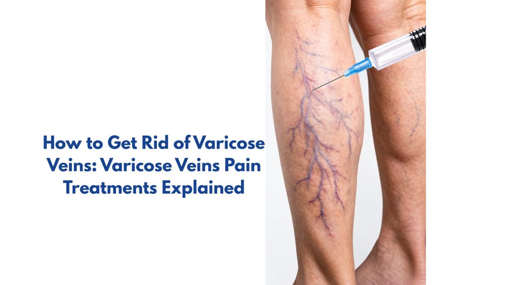 How to Get Rid of Varicose Veins: Varicose Veins Pain Treatments Explained