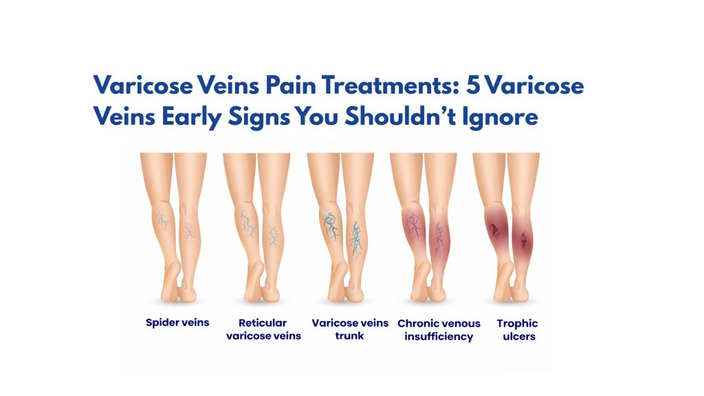 Varicose Veins Pain Treatments: 5 Varicose Veins Early Signs​ You Shouldn’t Ignore