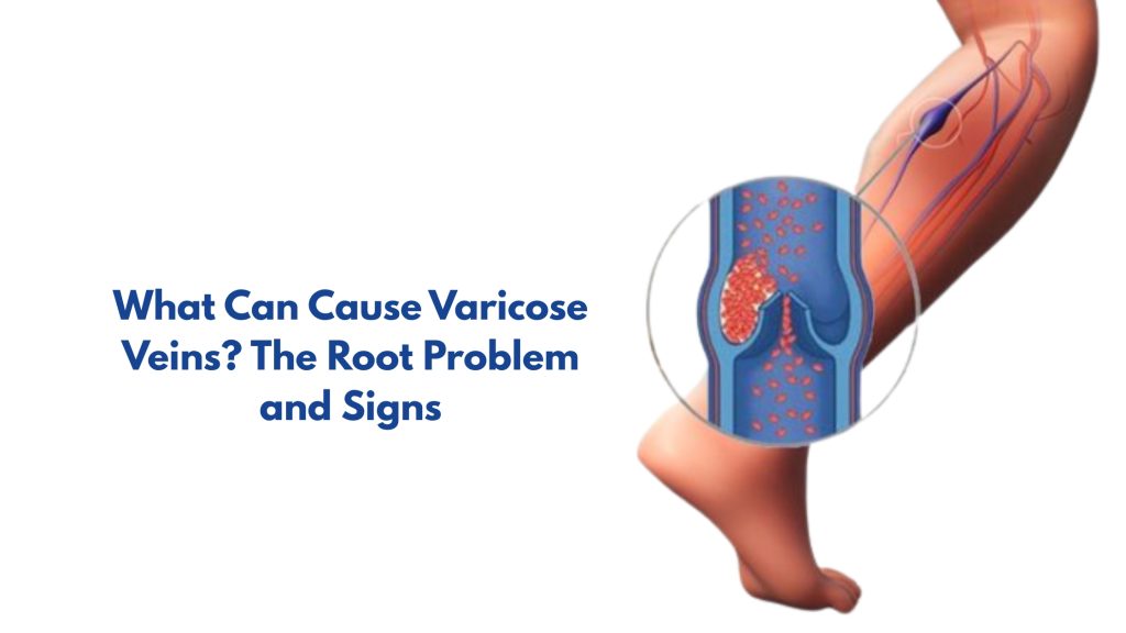 What Can Cause Varicose Veins​? The Root Problem and Signs