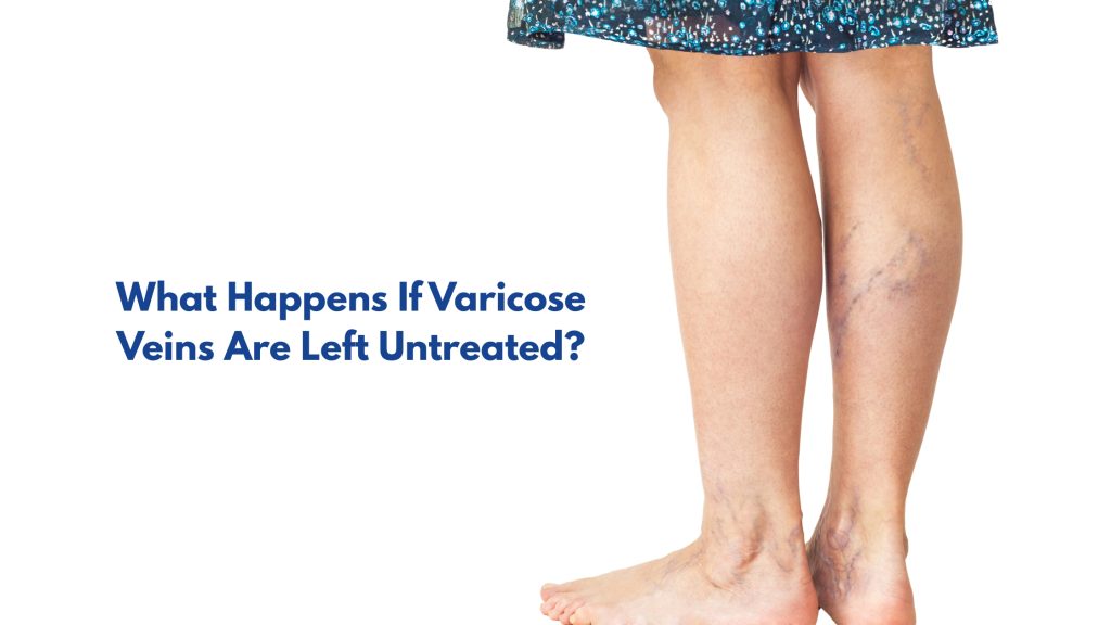 What Happens If Varicose Veins Are Left Untreated?