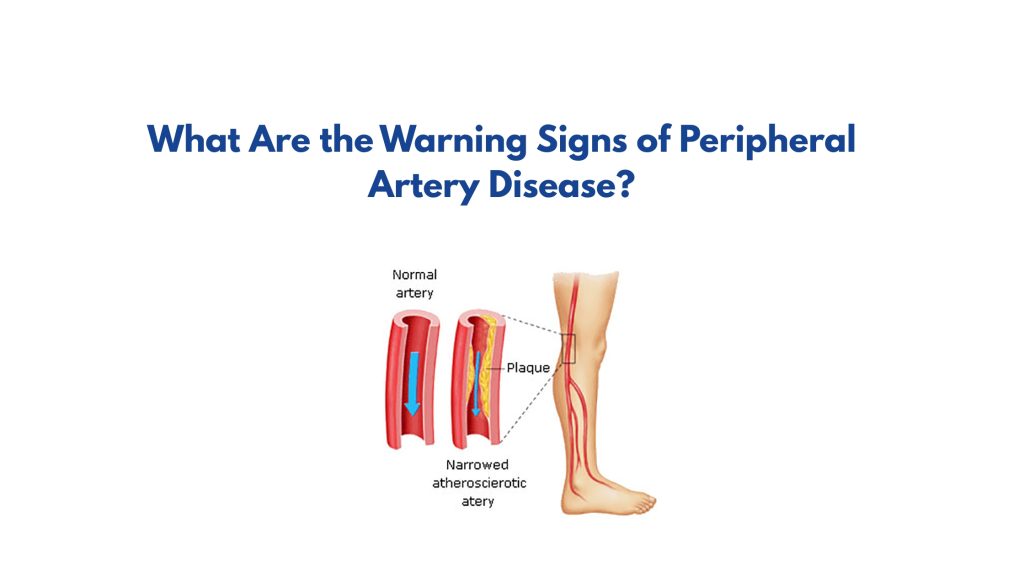 What Are the Warning Signs of Peripheral Artery Disease?