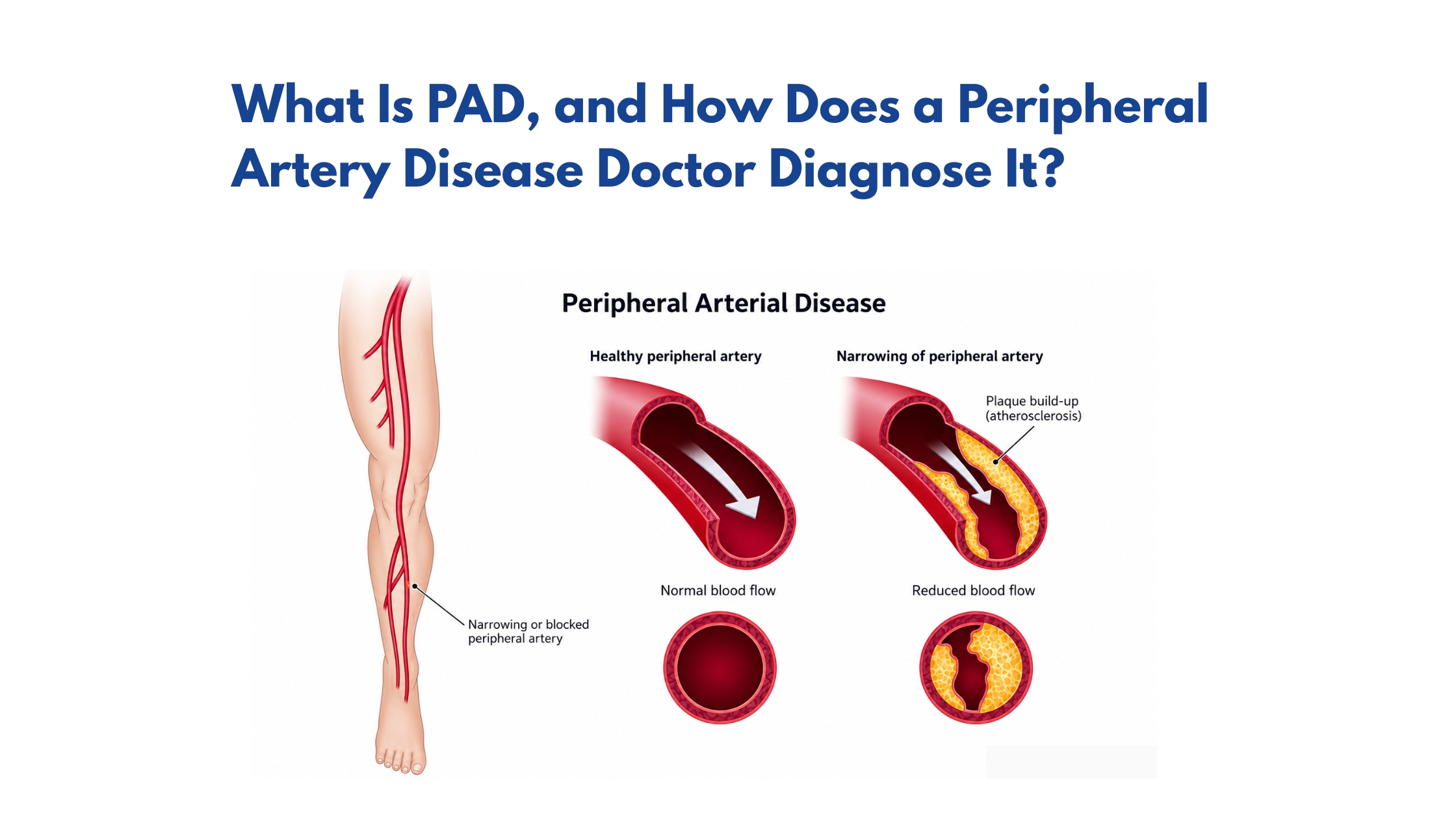 What Is PAD, and How Does a Peripheral Artery Disease Doctor Diagnose It?