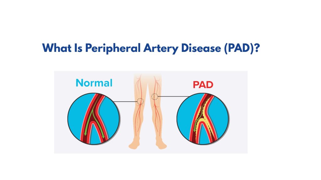 What Is Peripheral Artery Disease (PAD)?