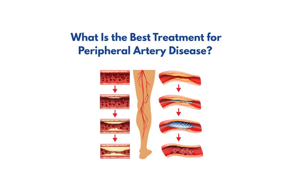 What Is the Best Treatment for Peripheral Artery Disease?