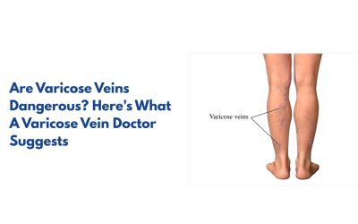Are Varicose Veins Dangerous? Here’s What A Varicose Vein Doctor Suggests