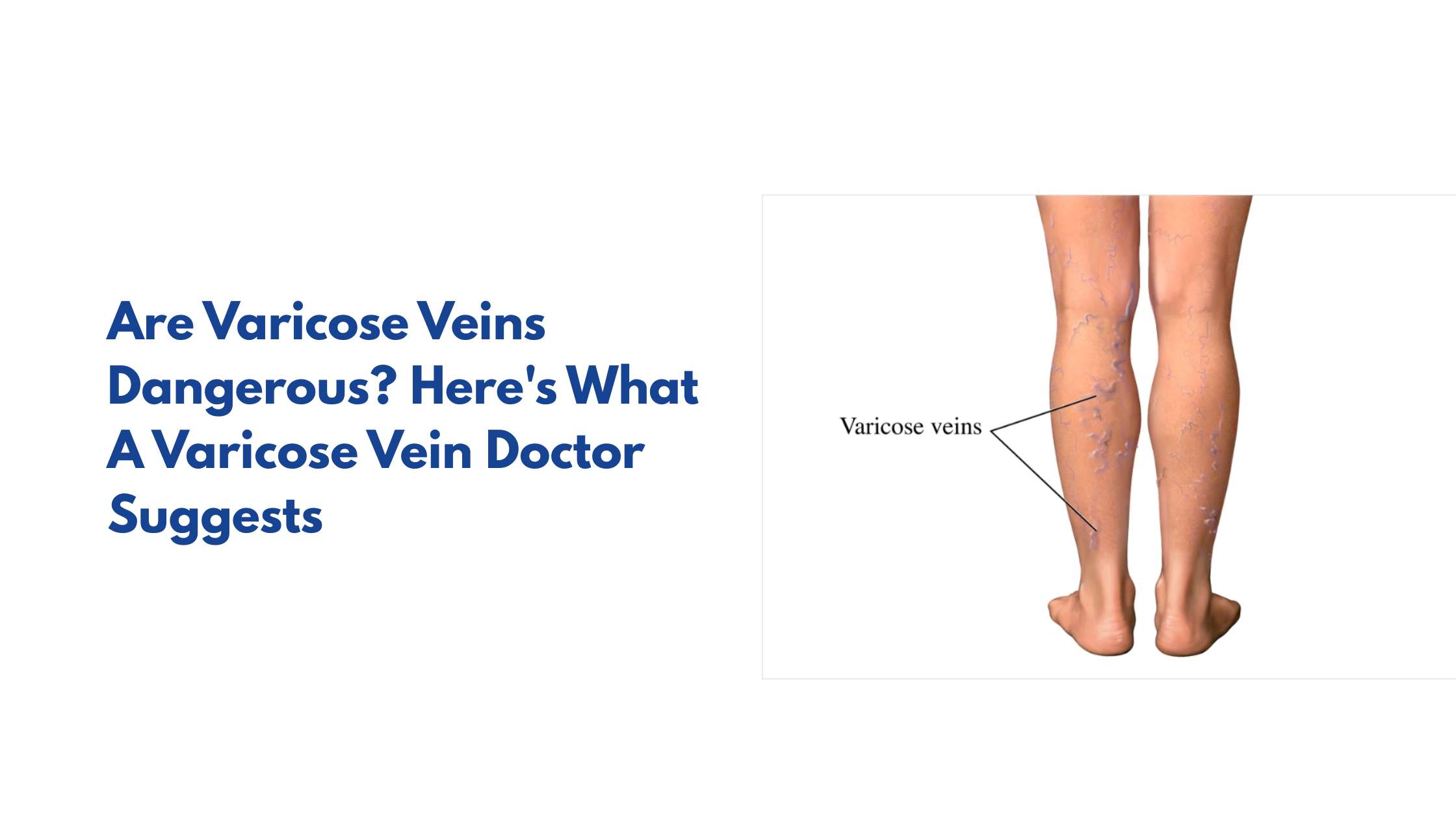 Are Varicose Veins Dangerous? Here's What A Varicose Vein Doctor Suggests