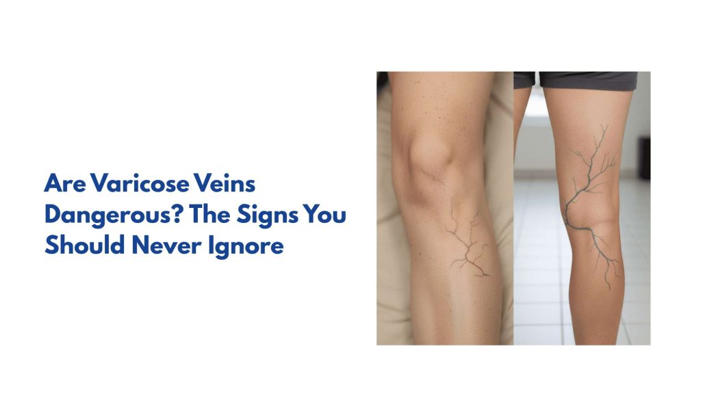 Are Varicose Veins Dangerous? The Signs You Should Never Ignore