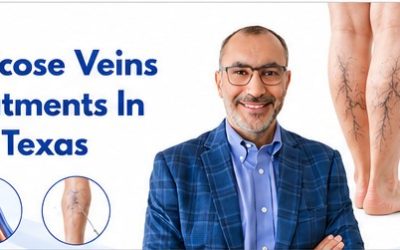 Best Varicose Veins Pain Treatments In Webster, Texas