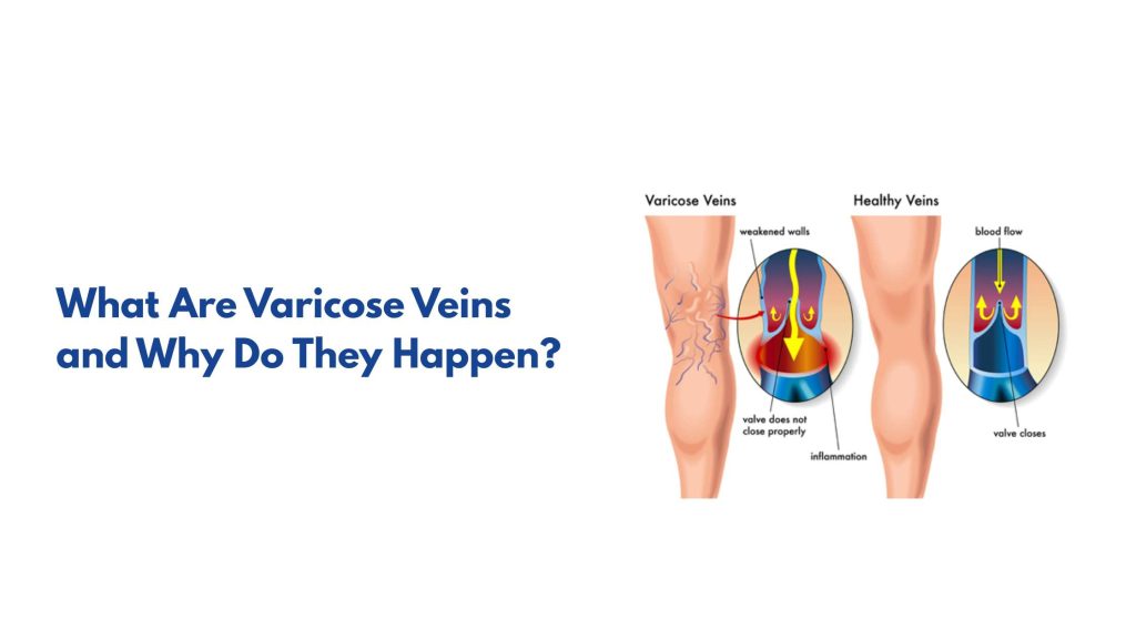 What Are Varicose Veins and Why Do They Happen?